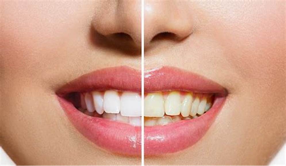 Conquering Coffee Stains: Teeth Whitening for Sensitive Souls